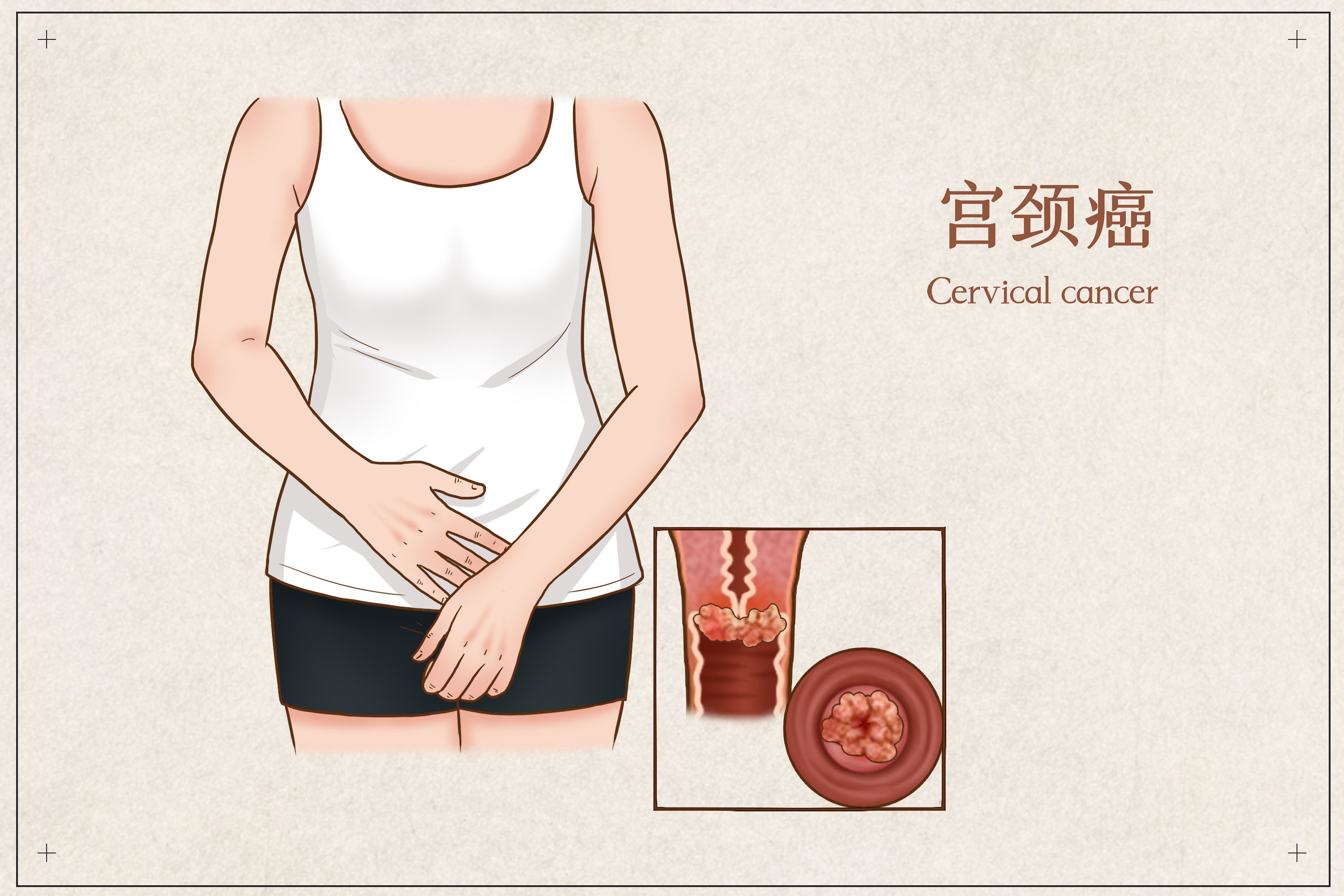 案例分享 | 免疫细胞疗法成功治愈宫颈癌患者